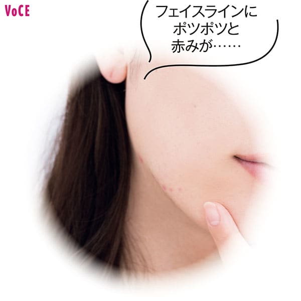 井手上さん/フェイスラインにポツポツと赤みが……