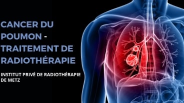 Metz Radiothérapie cancer poumon