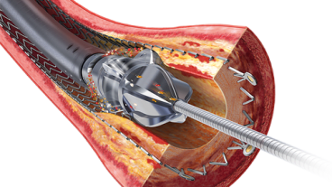 Innovation dans le traitement des maladies vasculaires chp brest jetstream