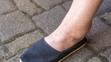 rétention d'eau jambe