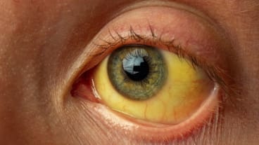 Hepatites : journée mondiale le 28 juillet 2024. Image d'un oeil dont le fond est jaune, symptôme de jaunisse, en lien possible avec une hépatite.