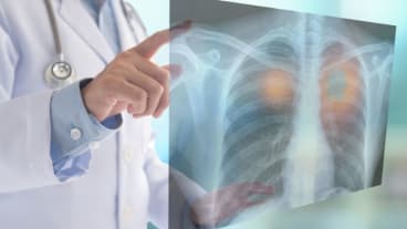 Cancer du poumon : peut-on guérir d'un cancer à petite cellule CPPC ? Image d'un médecin en blouse blanche pointant une radiographie des poumons.