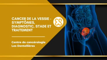 Cancer de la vessie – Symptômes, diagnostic, stade et traitement