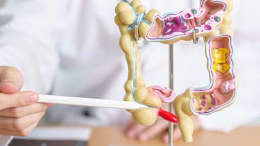 Diverticulose colique : quels liens avec la diverticulite ou sigmoïdite ? Un médecin montre un modèle en plastique figurant les intestins.