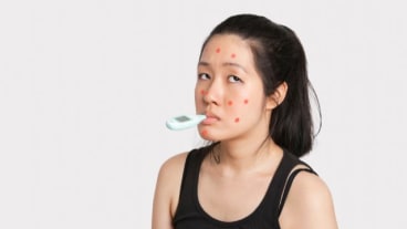 Rougeole : l'Organisation mondiale de la santé (OMS) alerte. Une jeune femme touchée par la rougeole, avec des boutons sur le visage et un thermomètre dans la bouche.