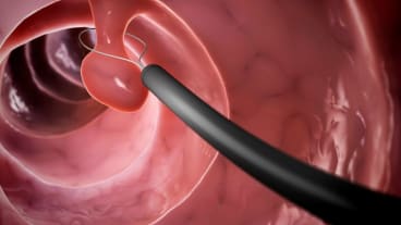 Combien de temps met un polype pour devenir cancéreux ? Image de synthèse où l'on voit un polype en train d'être extrait.