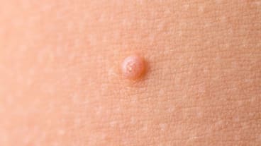 Comment savoir si un nodule est cancéreux ? Image d'un nodule sur la peau.