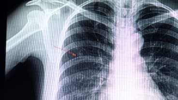 Peut-on vivre avec des nodules aux poumons ? Photo issue d'une imagerie médicale montrant en haut à gauche du thorax une tache : il s'agit d'un petit nodule.