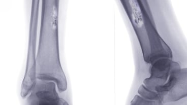 Quel examen pour détecter un cancer des os ? Image d'une radiographie des tibias montrant un cancer des os..