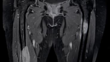 Quelles sont les métastases du cancer de la vessie ? Image en noir et blanc d'une IRM montrant des tumeurs métastatiques du fémur.
