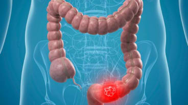 Quels sont les premiers symptômes du cancer du colon ? Image de synthèse d'un côlon où la zone cancéreuse est figurée par un point rouge.