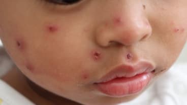 Rougeole : sa recrudescence en 2025 inquiète. Gros plan sur le visage d'un enfant, parsemé de boutons rouges.