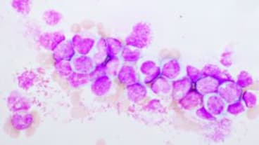 Peut-on guérir d’une leucémie myéloïde chronique. Image de cellules leucémiques.