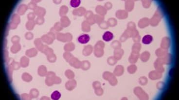 Leucémie lymphocytaire chronique c’est quoi ? Image de cellules dans le cadre d'une leucémie lymphocytaire chronique.