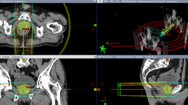 Essai clinique PEACE 7 - ICPN