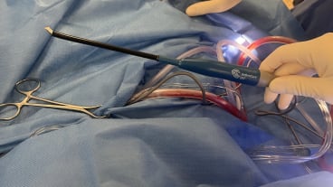 ORL amygdalectomie par coblation