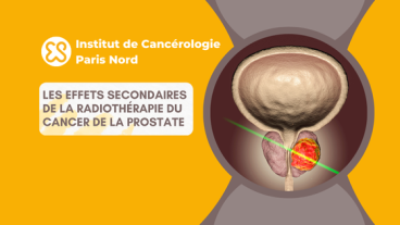 Les effets secondaires de la radiothérapie sur cancer prostate