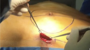 Mastectomie endoscopique réalisée à la Polyclinique Vauban à Valenciennes