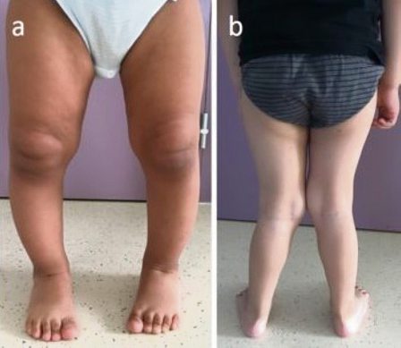 troubles de la démarche