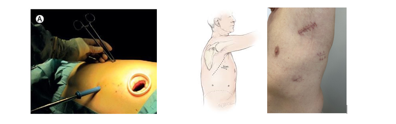 Intervention sans ouverture du thorax 