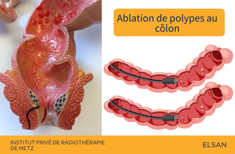 Ablation polypes du côlon