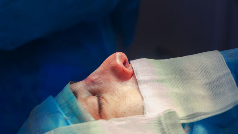 Nose surgery in Lyon: where to have the operation? Face of a sleeping man on an operating table with a compress at the base of his nose.