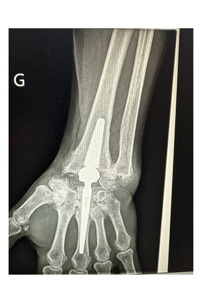 Prothèse de poignet