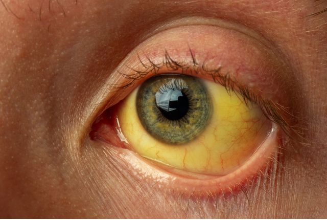 Hépatite A : définition, causes et traitements. Image d'un œil dont le blanc est coloré en jaune.