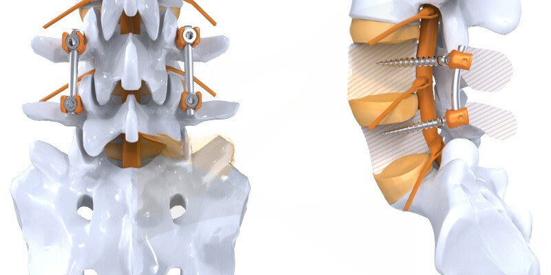 arthrodèse lombaire