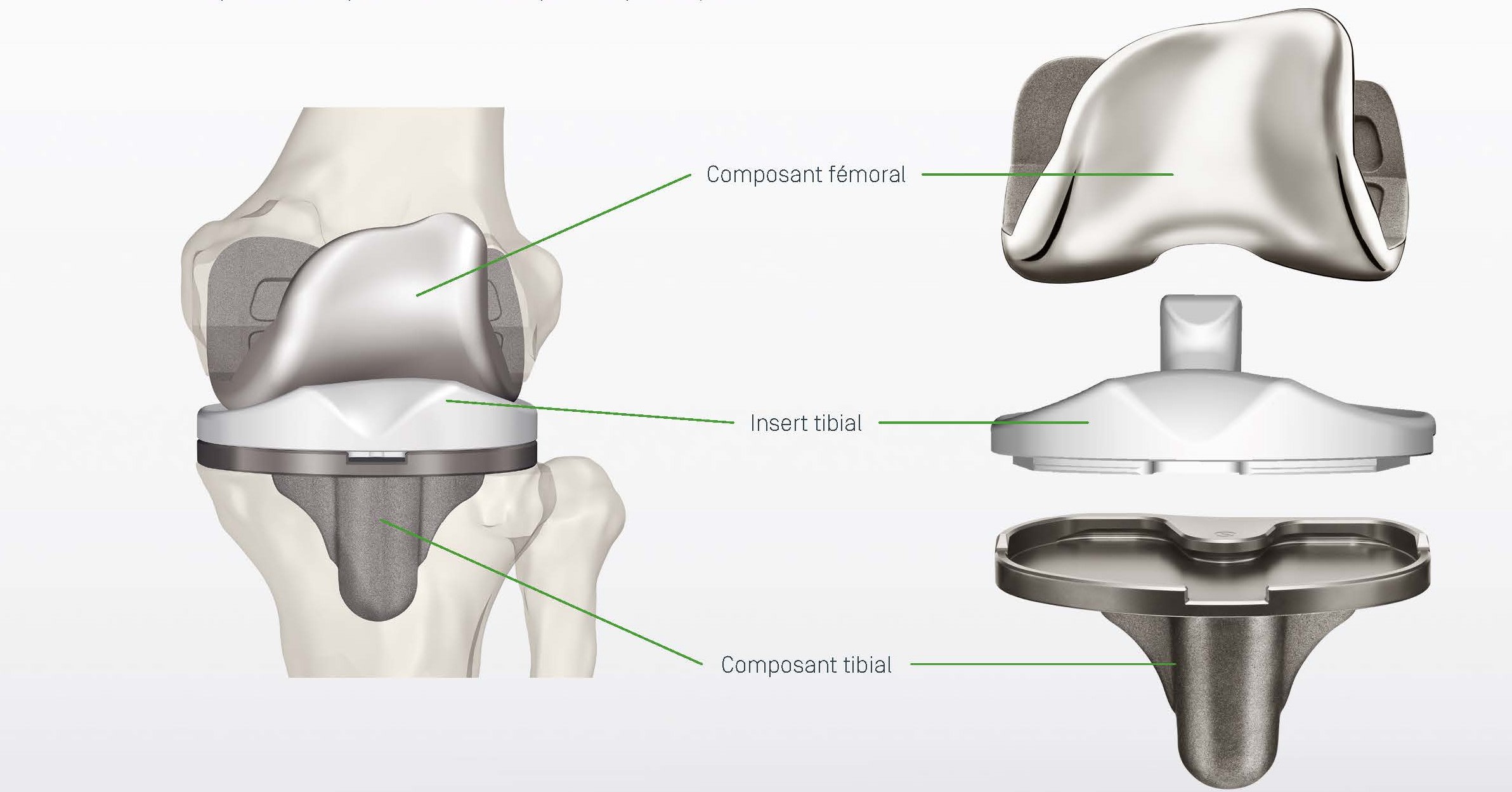 Prothèse genou sur mesure 