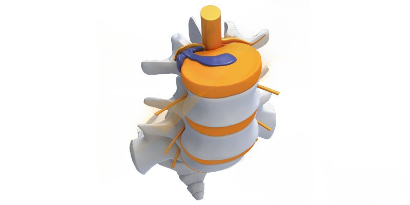 hernie discale lombaire