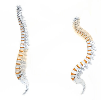 hypercyphose thoracique