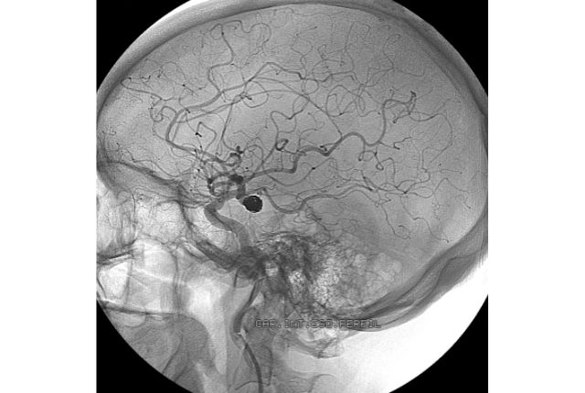 Rupture d’anévrisme