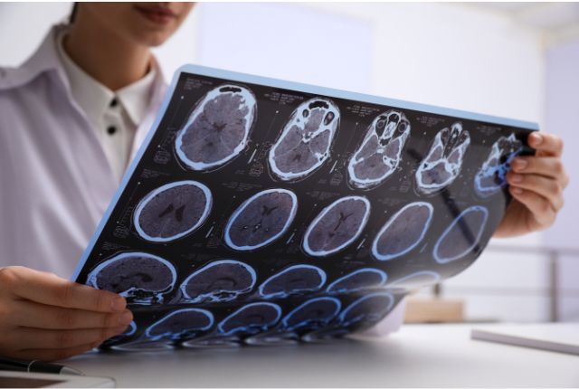 Sclérose en plaques : professionnelle analysant des radios du crâne.