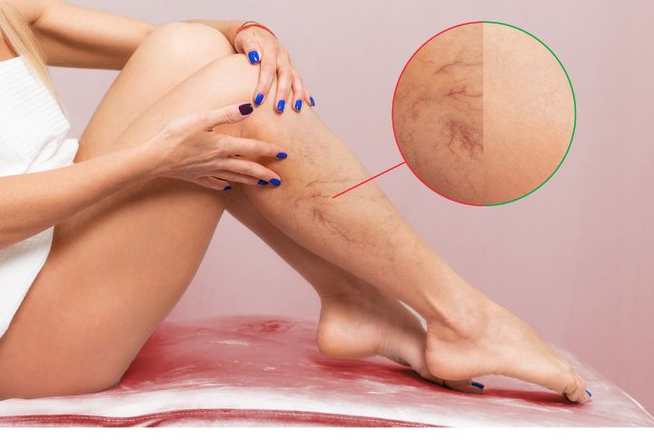 Thrombose : image d'une thrombose veineuse localisée au niveau des jambes d'une femme