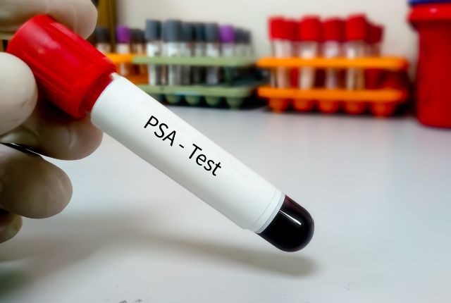 A partir de quel taux de PSA faut-il s'inquiéter ? Image d'un tube de laboratoire rempli de sang destiné à un dosage du PSA.