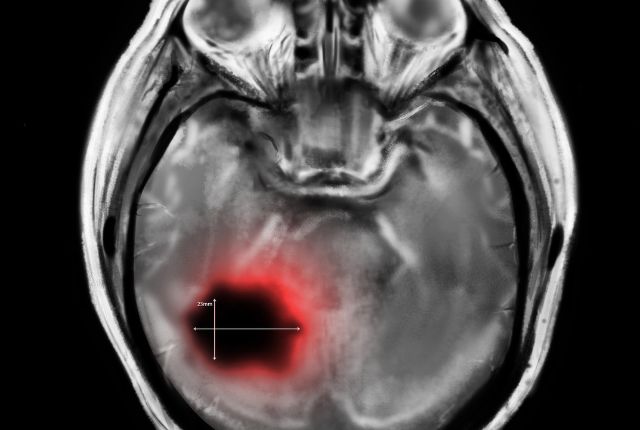 Astrocytome : définition, cause, soin, espérance de vie.  Cliché d'imagerie médicale montrant une tumeur dans la partie gauche du cerveau.