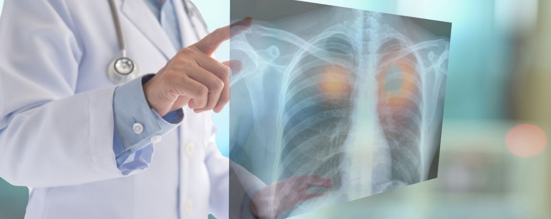 Traitement cancer poumon