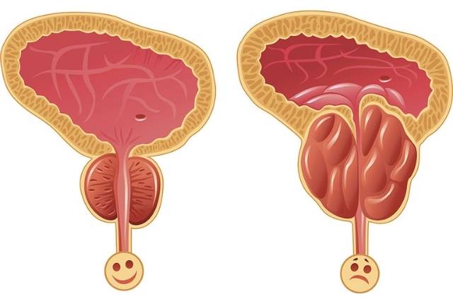 cancer de la prostate symptomes