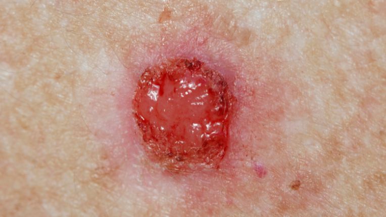 Quels sont les différents types de cancer de la peau ? Image d'un carcinome basocellulaire rouge et bombé.