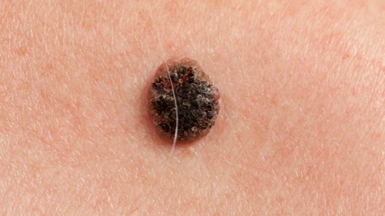 Quels sont les différents types de cancer de la peau ? Image d'un carcinome épidermoïde à l'aspect granuleux et marron foncé.