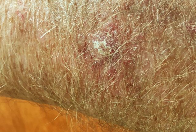 Carcinome épidermoïde : définition, pronostic, photo  : Photo d'un cancer épidermoïde de la peau sur l'avant-bras.