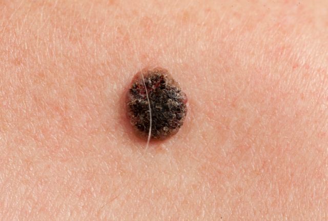 Carcinome épidermoïde : définition, pronostic, photo. Photo d'un carcinome épidermoïde kératinisant de la peau.