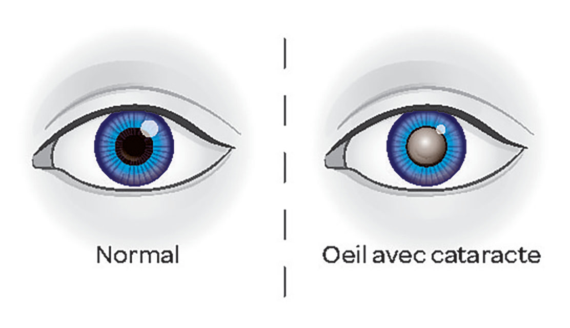 cataracte
