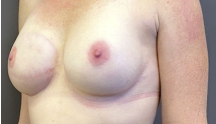 Chirurgie esthétique : une belle reconstruction du sein. Image du sein après.