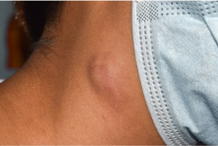 Comment savoir qu'on a un cancer ? image d'un ganglion gonflé à la base de la joue.