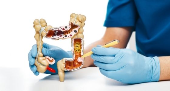 Dépistage du cancer du colon toutes les explications