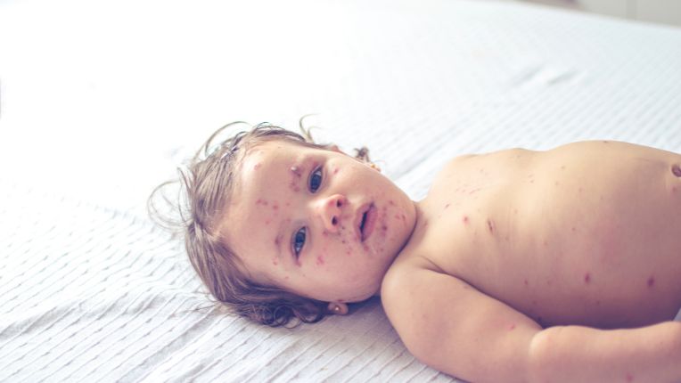 Petite fille allongée avec des boutons de rougeole. L'OMS alerte sur la progression des cas en Europe début 2024.