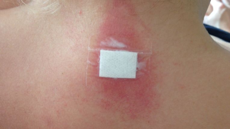 Est-ce que biopsie veut dire cancer ? Image du cou d'une femme avec un pansement à l'endroit où on lui a fait un prélèvement. La zone est rouge.