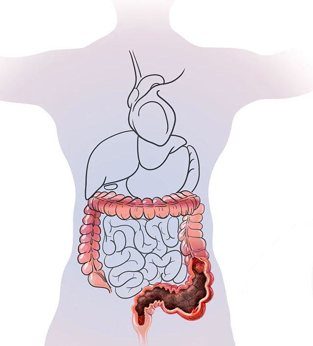 felacome ou bouchon de selles
